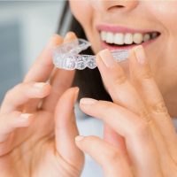 Erwachsene, Aligner und Alltag: Was vor einer Zahnkorrektur zu bedenken ist